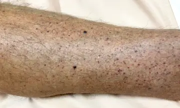 Gambe con puntini rossi, possibili segni di problemi di circolazione.